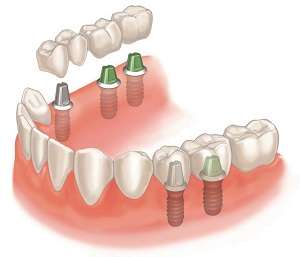 Осуществление протезирования зуба